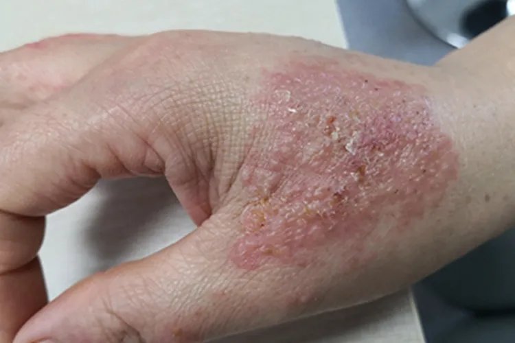 湿疹手背水疱图片