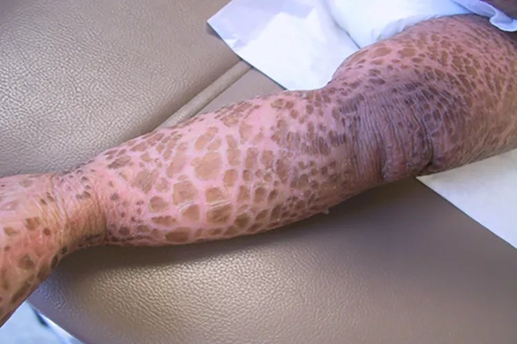 小腿皮肤干燥鱼鳞状图片