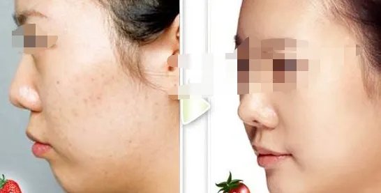 做果酸要多少钱一次