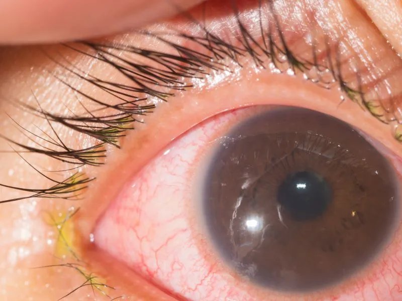 视力治疗的方法有哪些 