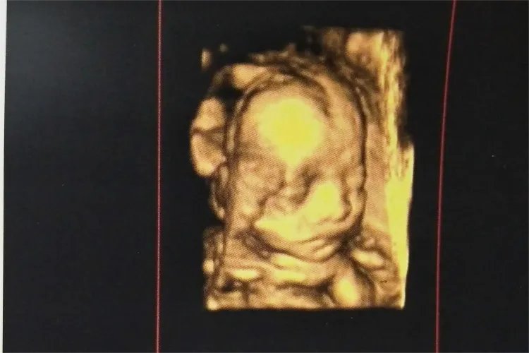 5个月大胎儿彩超照片