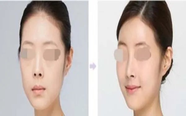 天津膨体隆鼻医院哪里好