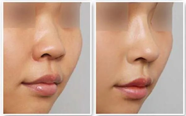 北京假体隆鼻去哪家医院好