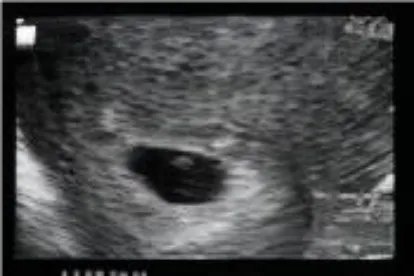 怀孕一个月的B超图片