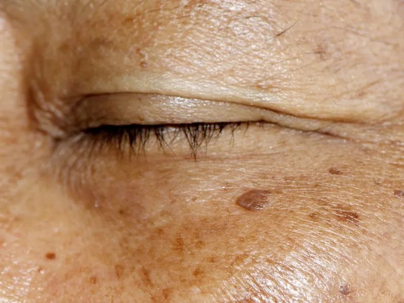 鸡蛋美容祛斑方法