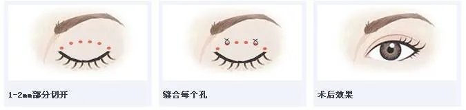 割双眼皮前后需要做些什么？