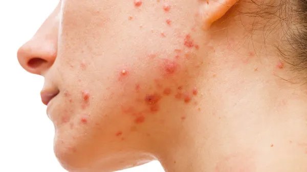 治痤疮要多少钱