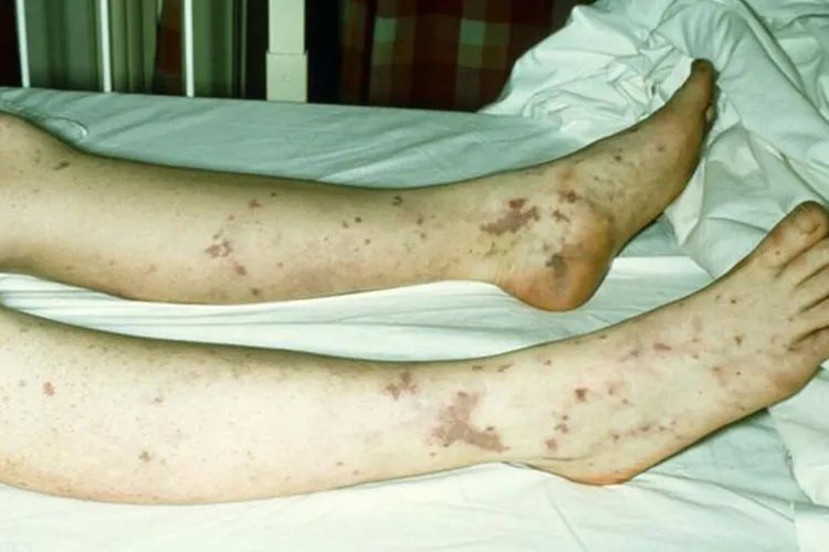 白血病出血点图片