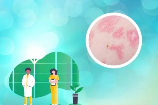 治疗牛皮癣的克星