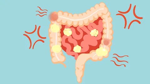 盆底痉挛综合症都有哪些表现