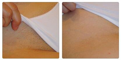 深圳永久性激光脱毛价格是多少