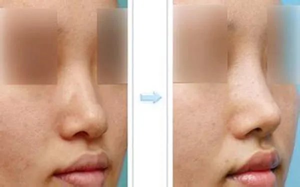 北京隆鼻哪些医院比较好？