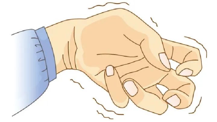 安徽省癫痫专家谈复杂的癫痫症状