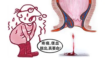 痔疮手术后有什么症状