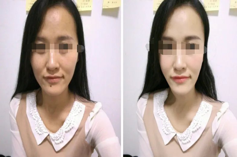 打美白针前后效果图