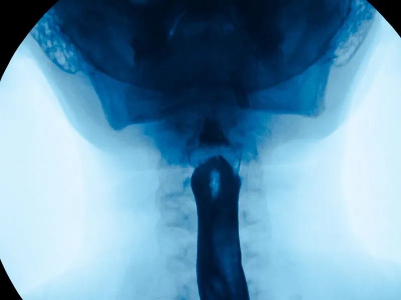 食道癌特效药有哪些