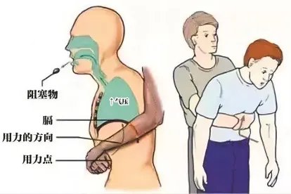 汤姆立克法急救法 施救的部位图片