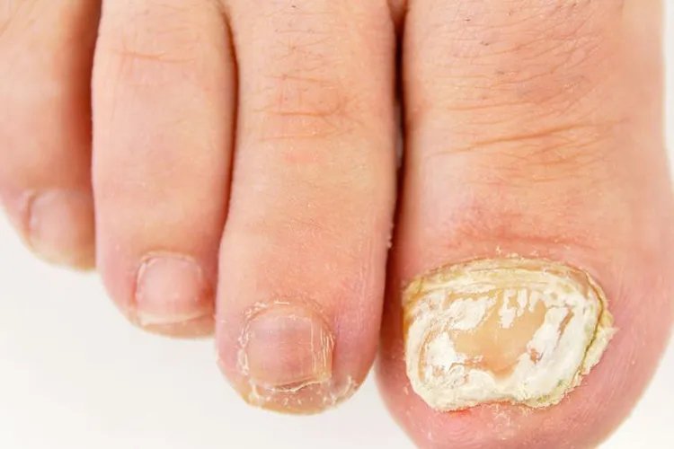 灰指甲早期图片