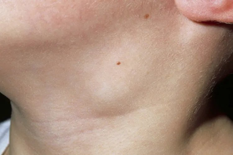 幼儿风疹的症状图片