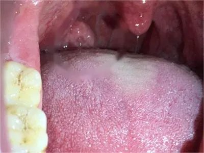 扁桃体癌肿块图片