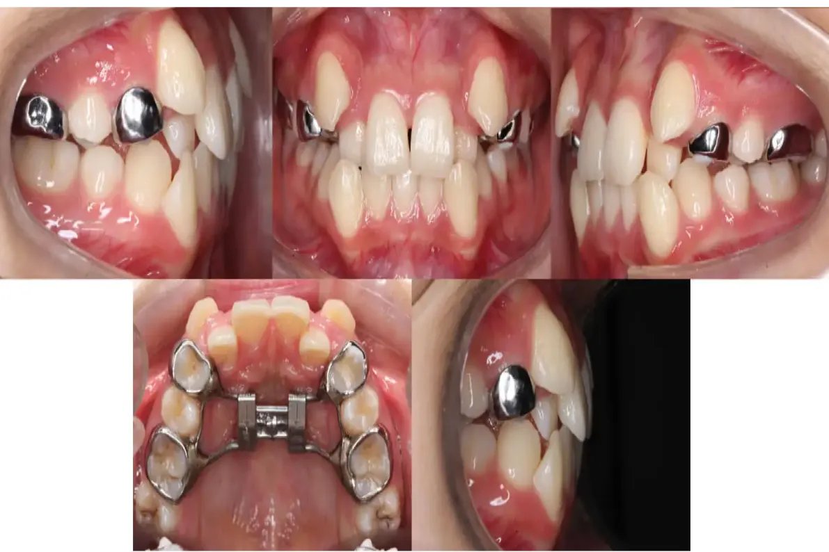 上颌扩弓器图片