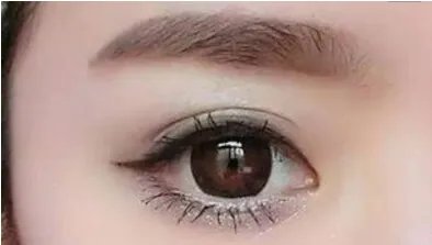 北京做埋线双眼皮多少钱