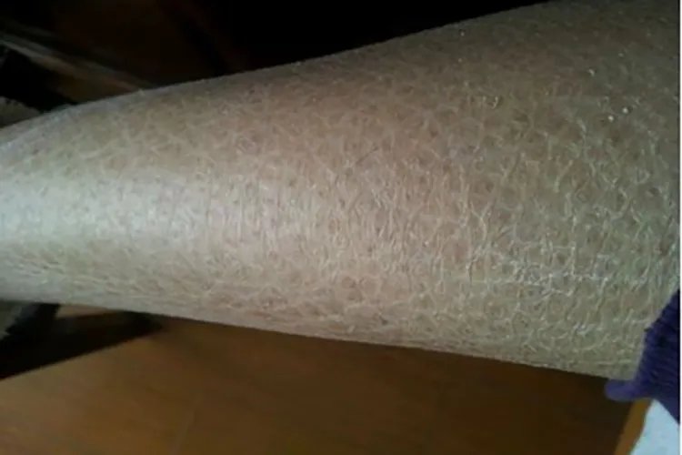 小腿皮肤干燥鱼鳞状图片