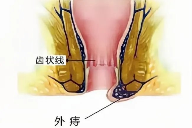 肛门齿状线位置