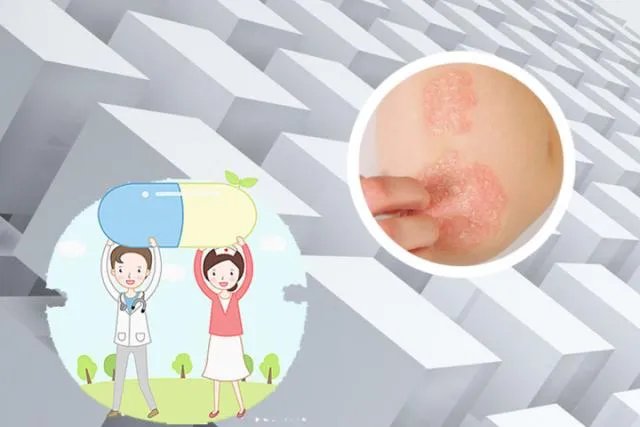 治疗牛皮癣的克星