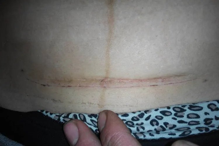 剖腹产刀口变化过程图