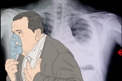 白肺能活多长时间