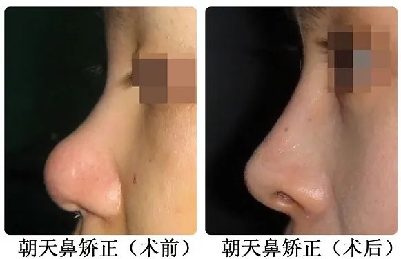 朝天鼻整形手术价格