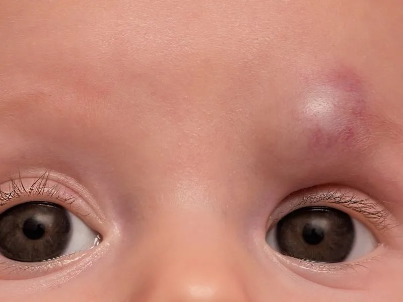 小儿颈部肿块的原因