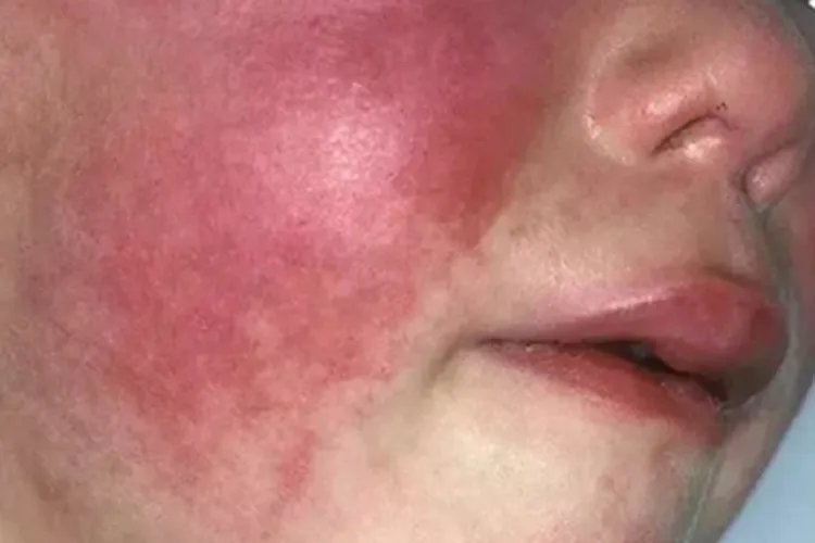 猩红热症状图片