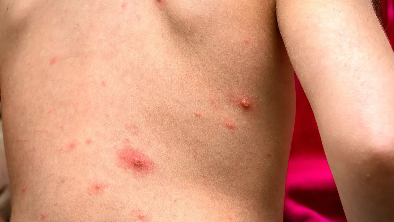 身上起红疙瘩很痒怎么办