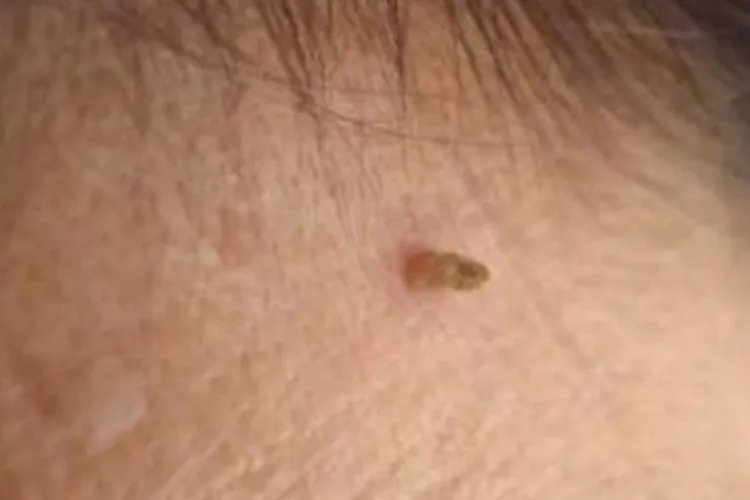 脖子上长了个疙瘩图片