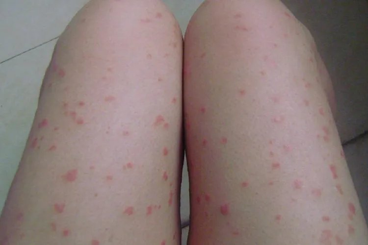 牛皮癣早期症状是什么样的