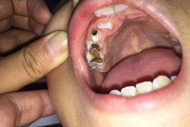 喝可乐烂了七八个牙根图片