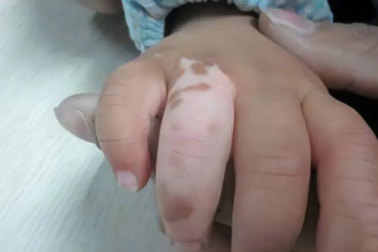 宝宝身上有白色斑块图片