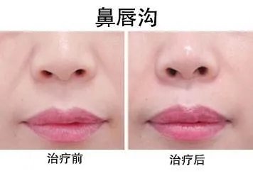 丰鼻唇沟手术多少钱