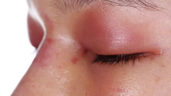 成都美容整形脸光子嫩肤失败如何补救