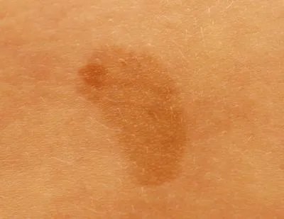 色斑如何形成 揭晓色斑的形成原因