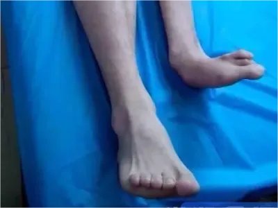先天性腓骨缺如小腿畸形图片