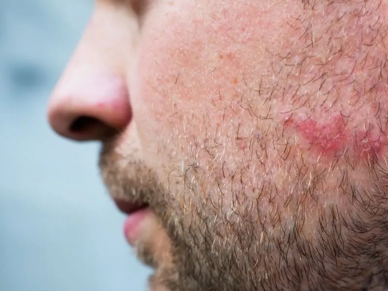 中药治皮肤过敏