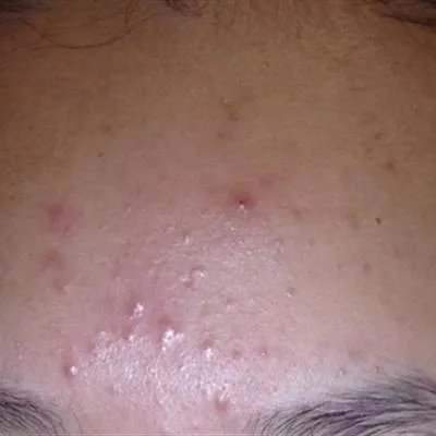 痤疮疙瘩是什么原因