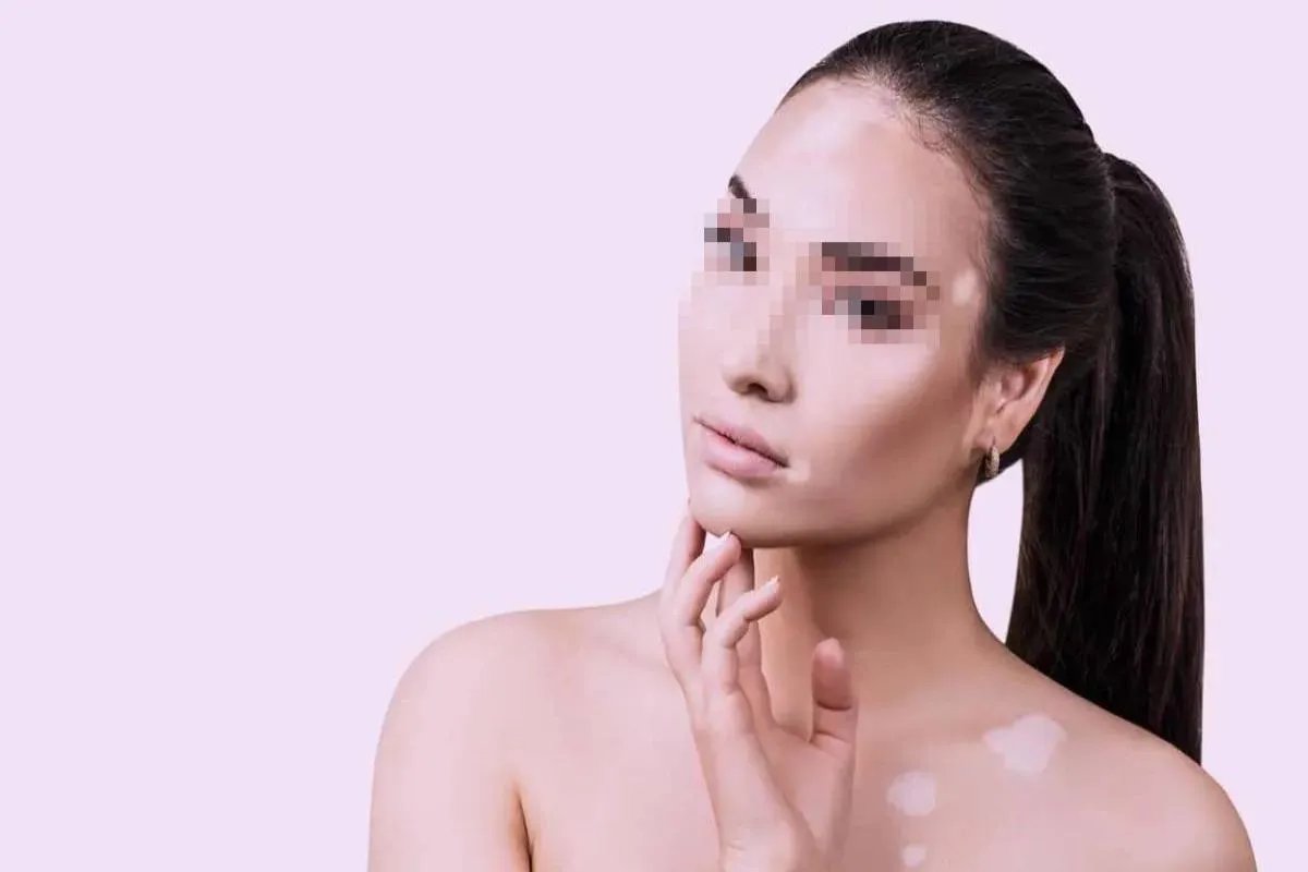 白颠疯病初期是什么样的症状