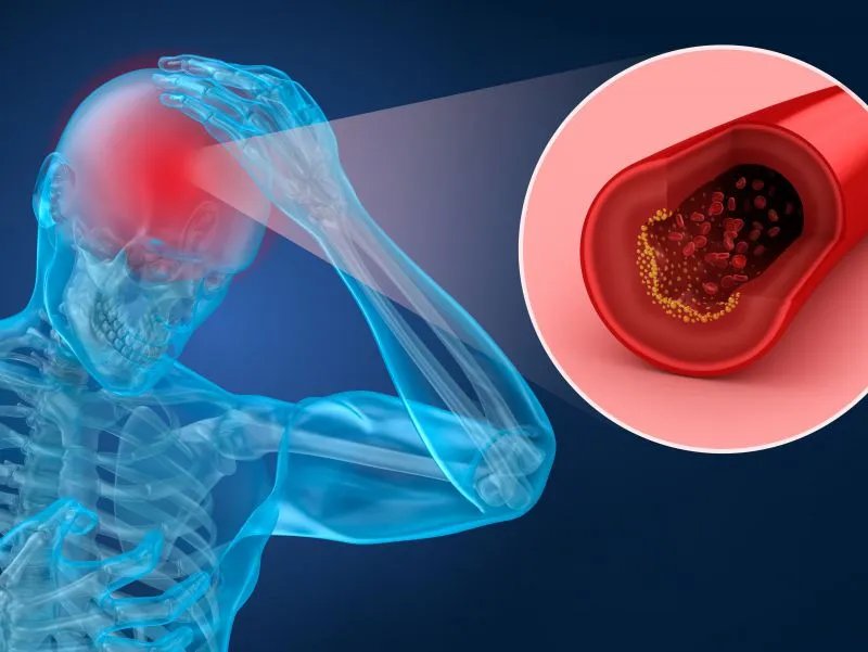 脑血管硬化吃什么好