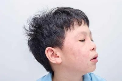 肝火旺脸上长斑应该怎么做