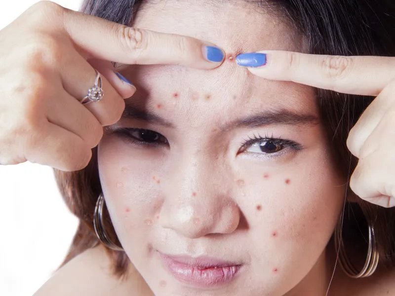 怎么才能不长青春痘