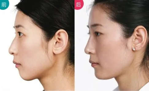 自体脂肪隆下巴的优势有哪些